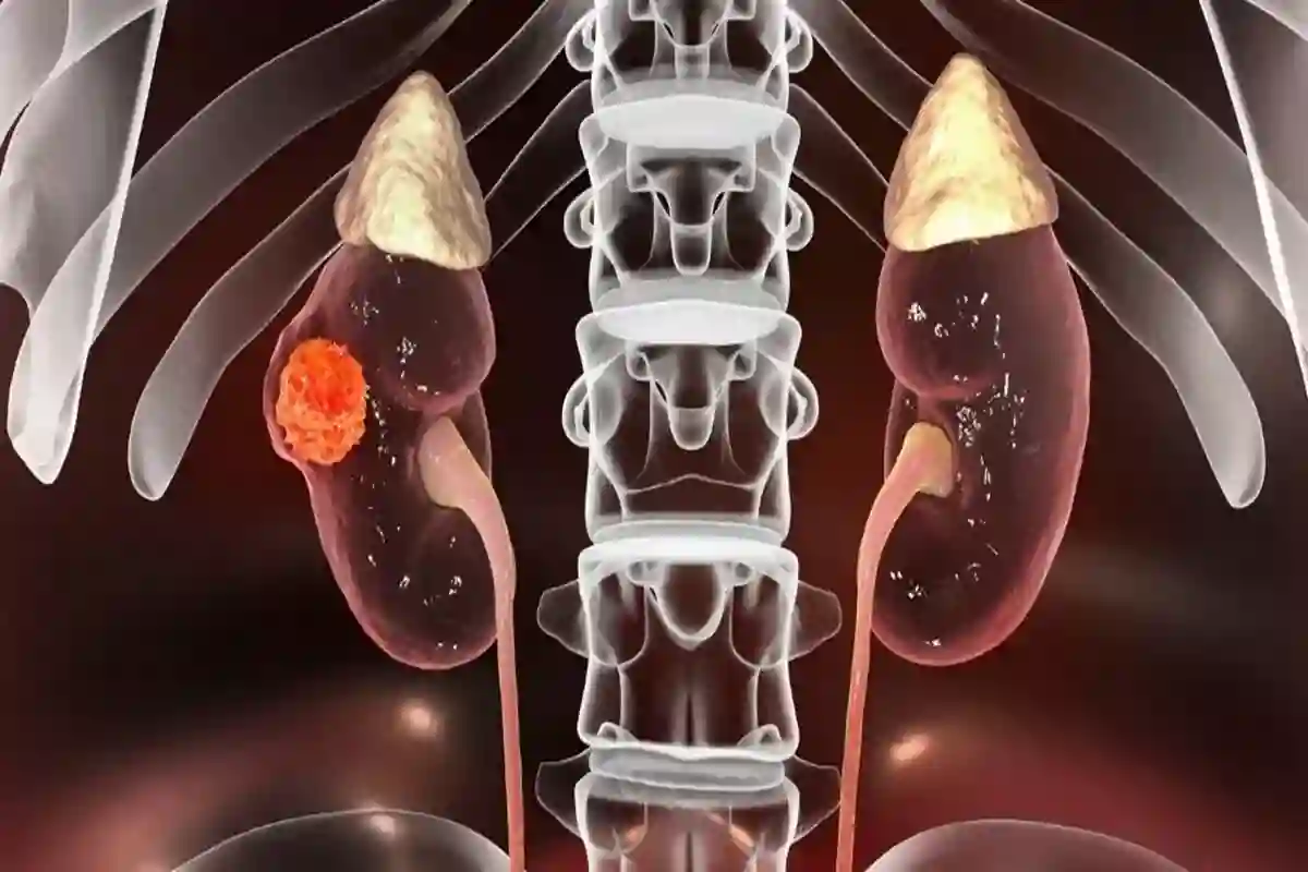 سرطان الكلى